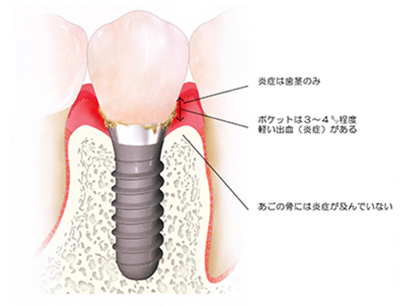 周囲炎の対策その1