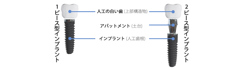 インプラント周囲炎の様々な原因